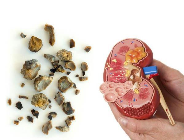 石淋,砂淋,小便带血 (西医学之肾结石)26