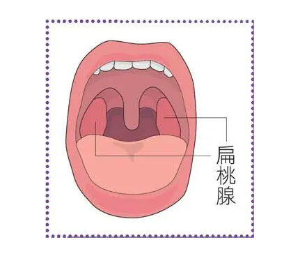 喉蛾方 (可比照西医学之扁桃腺发炎)，类似于仙丰制作的候蛾54号